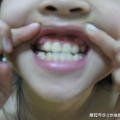 别拔虎牙,揭秘为何不宜拔除虎牙”